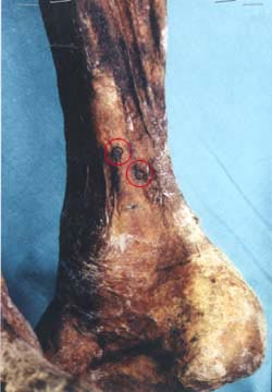 Abbildung des Knöchels von Ötzi mit Akupunktur-Punkten